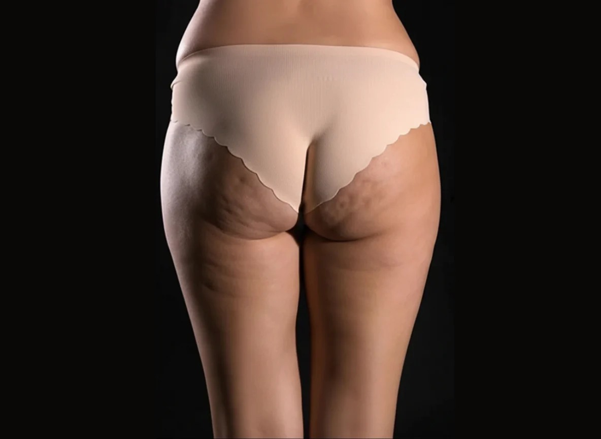Masajeador Anticelulítico Vibratorio Body Sculptural